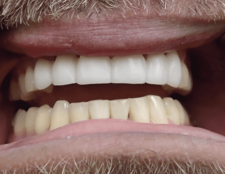 Smile-Makeover-with-Crowns-After-Image