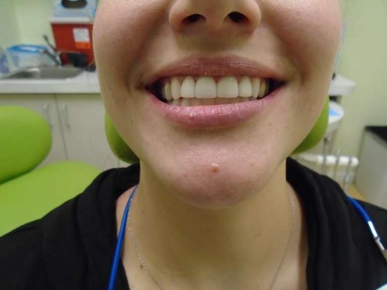 Veneers-1-After-Image