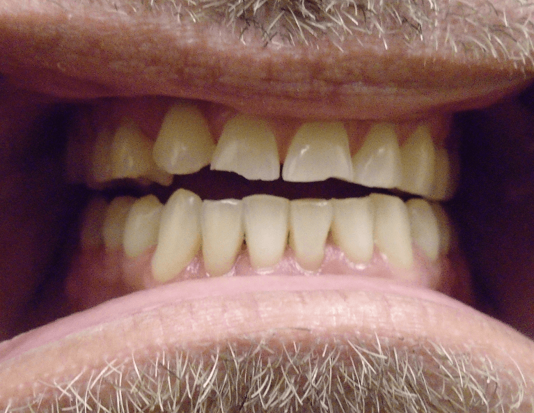 Smile-Makeover-with-Crowns-Before-Image