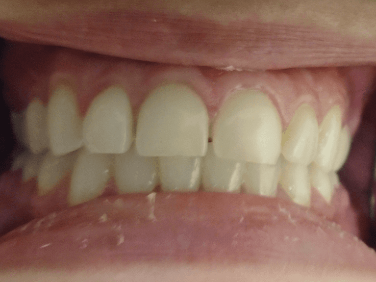 Veneers-1-Before-Image