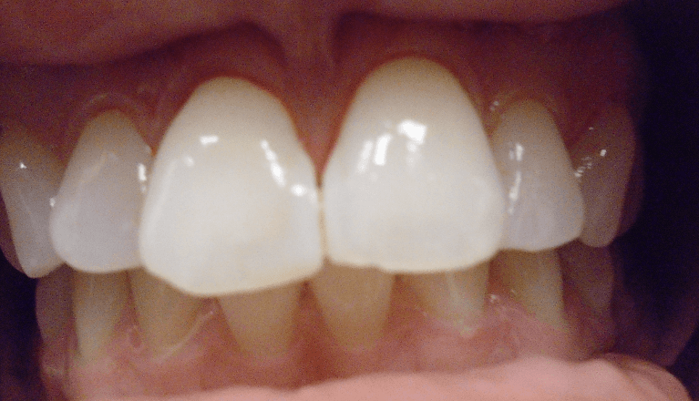 Veneers-2-Before-Image